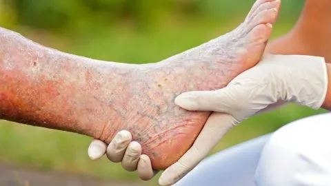 Stem Cell Treatment for Critical Limb Ischemia (CLI) in India