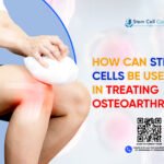 How Can Stem Cells be Useful in Treating Osteoarthritis?