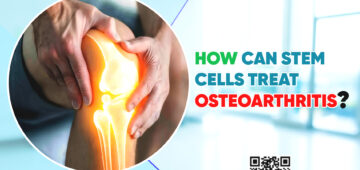 How Can Stem Cells Treat Osteoarthritis?