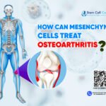 How Can Mesenchymal Cells Treat Osteoarthritis?