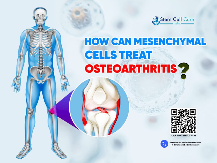 How Can Mesenchymal Cells Treat Osteoarthritis?