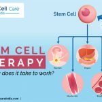 stem cell therapy