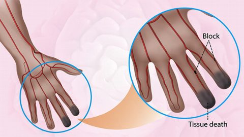 Stem Cell Treatment of Buerger’s in India