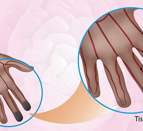 Stem Cell Treatment of Buerger’s