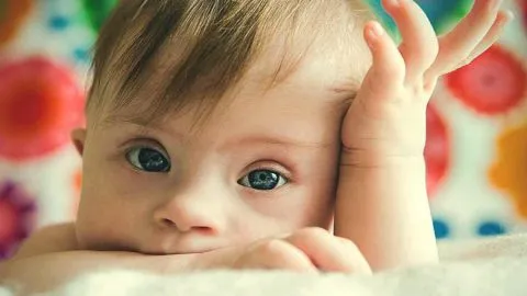Down Syndrome