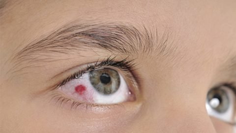 Eye Injuries