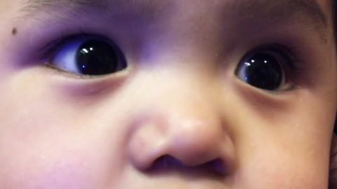 Optic Nerve Hypoplasia Stem Cell Treatment