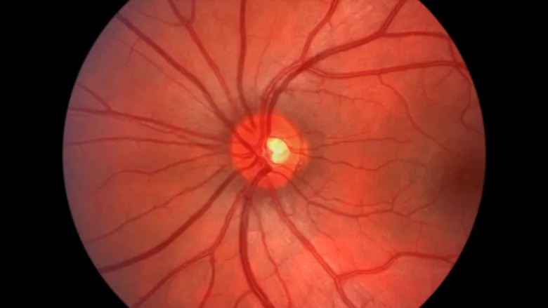 Optic-Neuropathy Optic Neuropathy