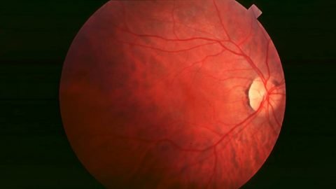 Retinitis Pigmentosa