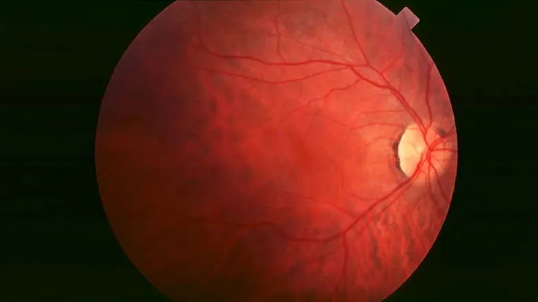 Retinitis Pigmentosa