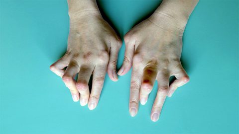 Stem Cell Treatment Rheumatoid Arthritis in Delhi, India