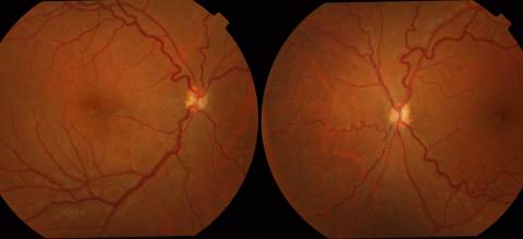 Optic nerve hypoplasia