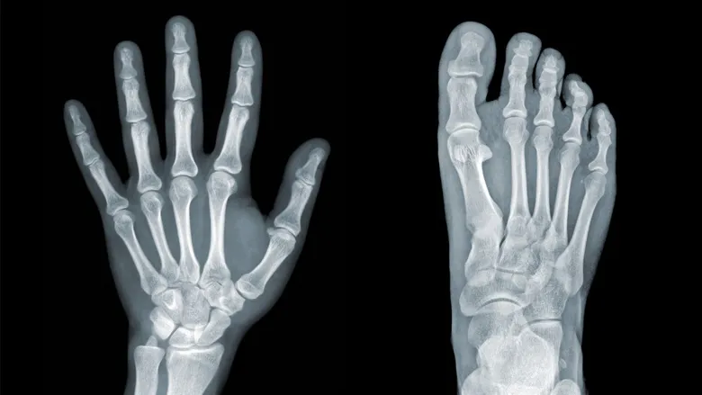 Stem Cell Treatment Osteopenia