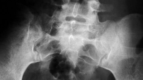 Stem Cell Treatment Osteopenia