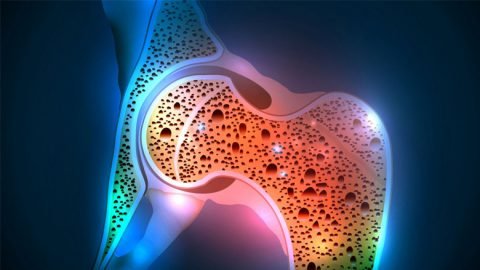 Stem Cell Treatment Osteoporosis