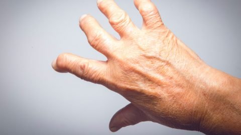 Stem Cell Treatment Rheumatoid Arthritis