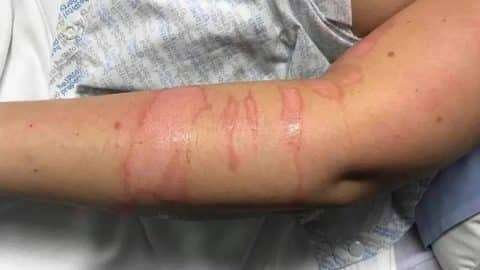Stem Cell Treatment