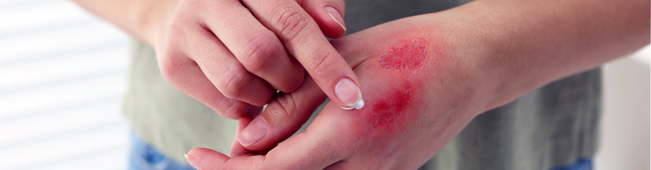 Stem Cell Treatment for Skin Burns Delhi, India