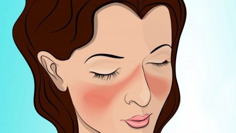 Stem Cell Treatment for Systemic Lupus