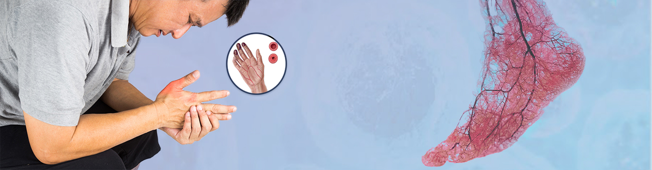 Stem Cell Treatment of Buerger’s in India