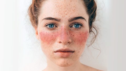Stem Cell Treatment for Systemic Lupus in Delhi, Noida