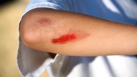 Major Skin Abrasions