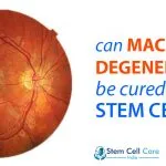 macular degeneration