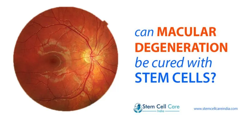 macular degeneration