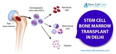 Stem Cell Bone Marrow Transplant In Delhi