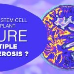 Can A Stem Cell Transplant Cure Multiple Sclerosis?