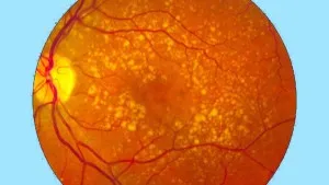 Age-Related-Macular-Degeneration