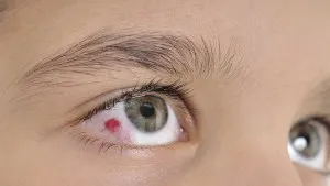 Eye-Injuries