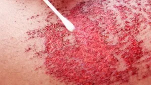 Major-Skin-Abrasions