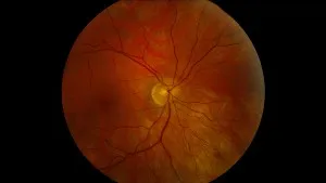 Optic-Nerve-Hypoplasia