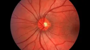 Optic-Neuropathy