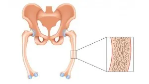 Osteomalacia