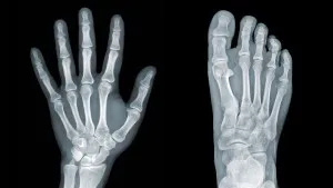Osteopenia-1