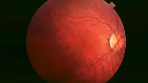 Retinitis-Pigmentosa