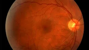 Retinopathy