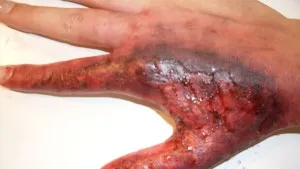 Skin-Burn