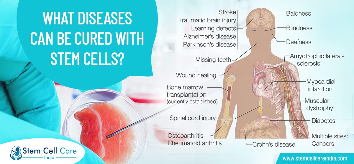 What Diseases Can Be Cured With Stem Cells?