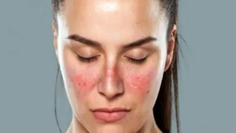 Lupus Stem Cell Treatment In India
