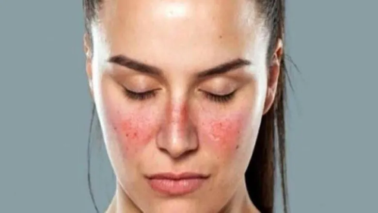 Lupus Stem Cell Treatment In India