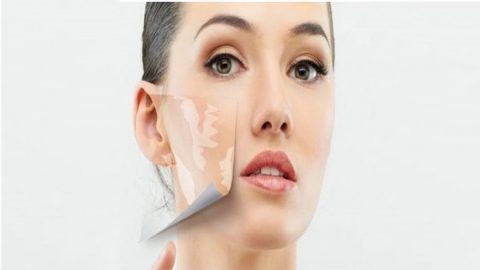 Vitiligo Stem Cell Treatment In India
