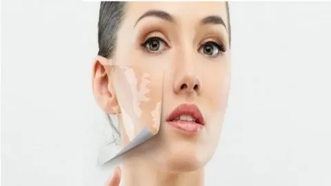 Vitiligo Stem Cell Treatment In India
