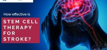 How Effective Is Stem Cell Therapy for Stroke