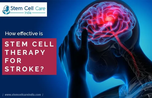 How Effective Is Stem Cell Therapy for Stroke