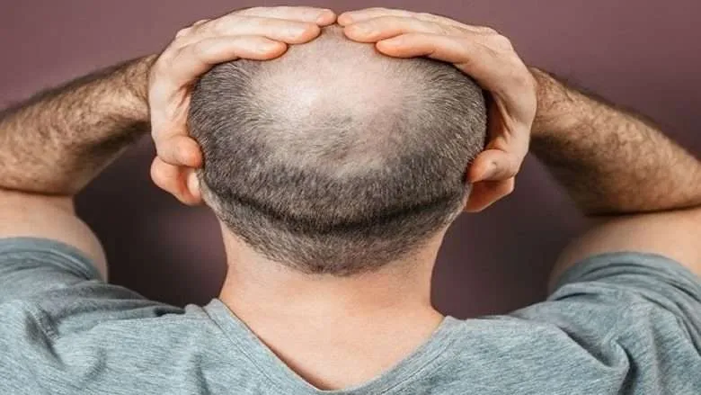 Hair Growth Encouraged Using Stem Cells