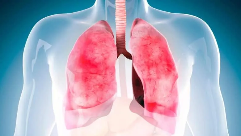 Stem Cell Therapy Might Help Treat Lung Inflammation and Damage Study