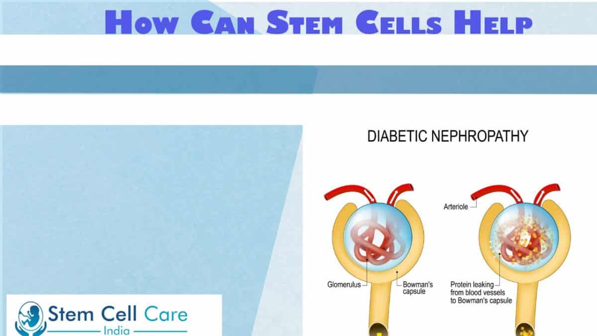Stem Cell Therapy